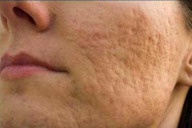 Key Pieces of Can Acne Scars Be Removed Naturally